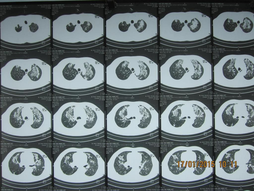 Ảnh chụp CT lúc vào viện